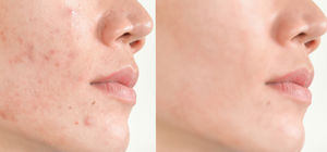 Different Types of Acne And Treatments